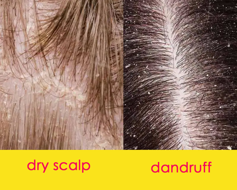 Dandruff vs. Dry Scalp, Can You Tell The Difference? - Hairstyles Weekly