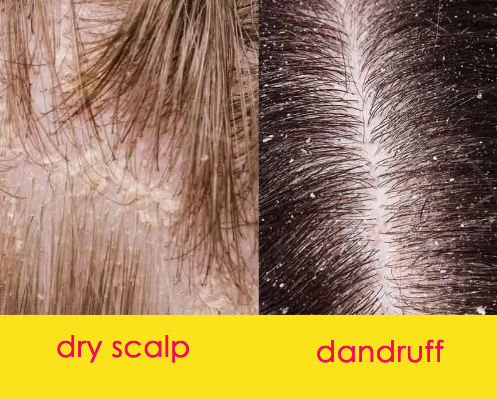 Dandruff Vs Dry Scalp Can You Tell The Difference Hairstyles Weekly 